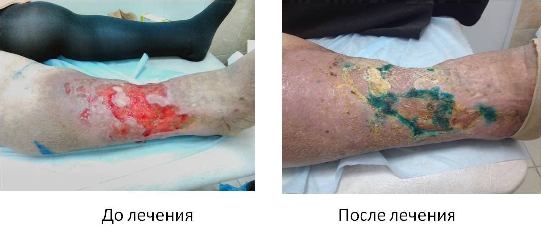 фото ног с варикозом