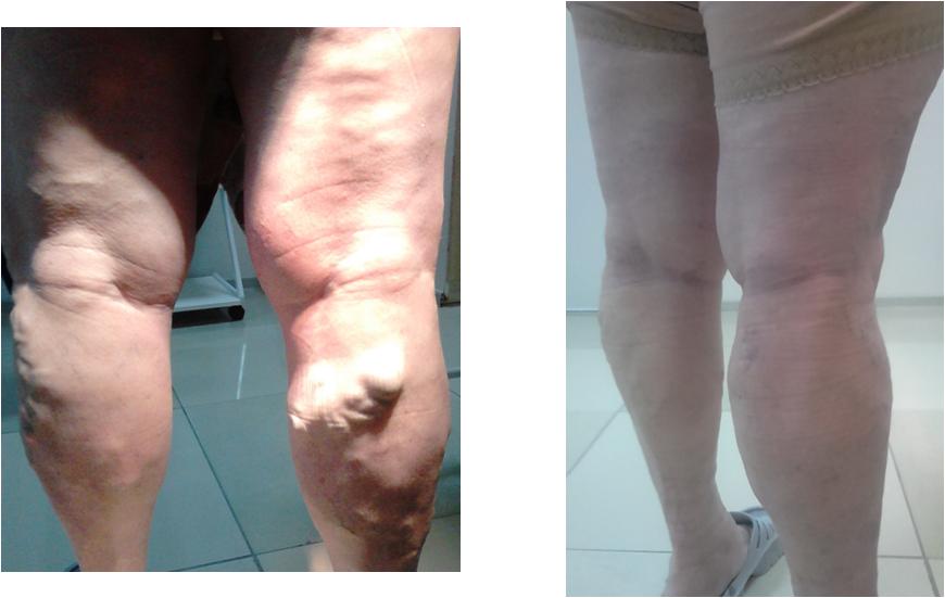 фото ног с варикозом