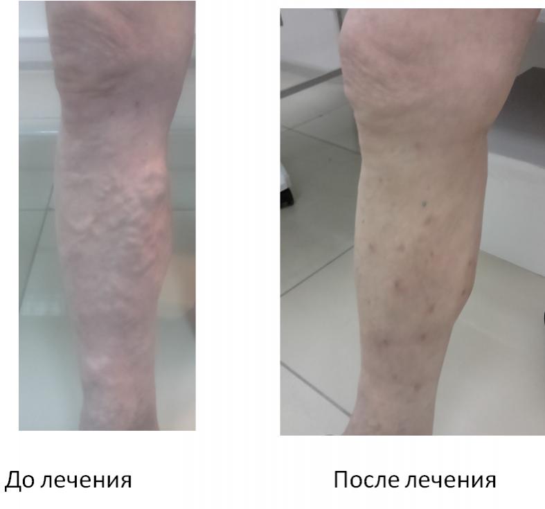 фото ног с варикозом