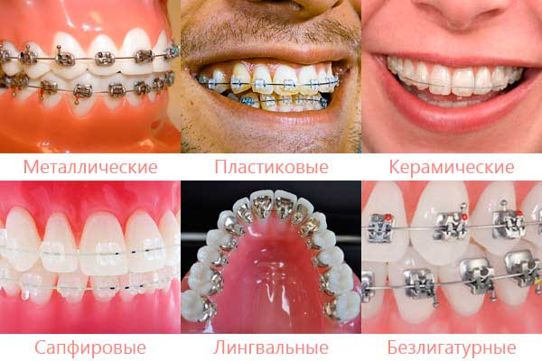 Пластиковые брекеты Томск Мечникова лучшая стоматология в томске отзывы