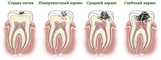 Лечение кариеса Томск Ветровая томск стоматология на мира 15