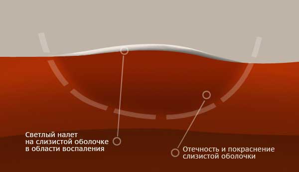 воспаление десен лечение