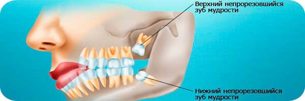 Удаление зуба Томск Вавилова лечение зубов томск